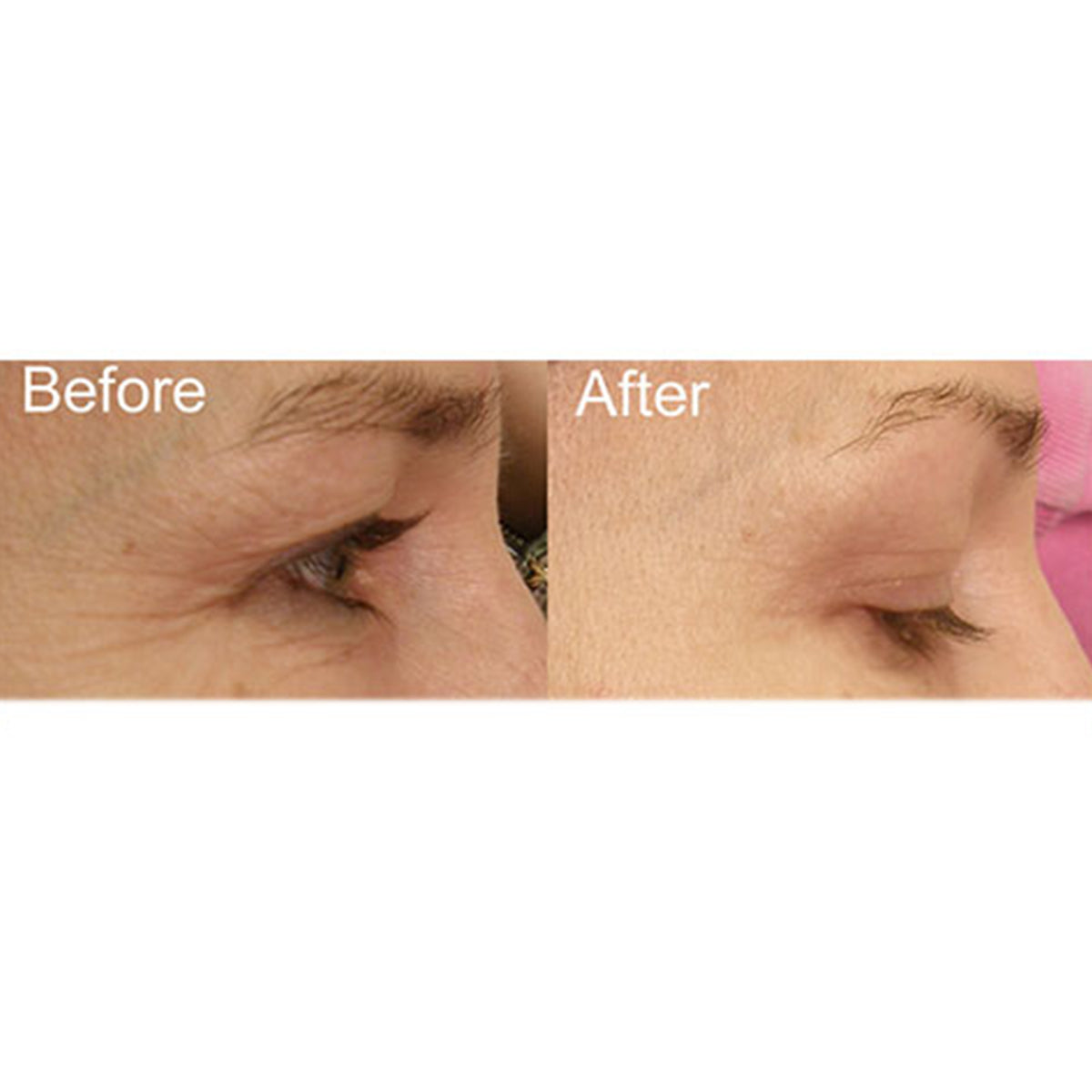Full Face Professional Light Therapy System