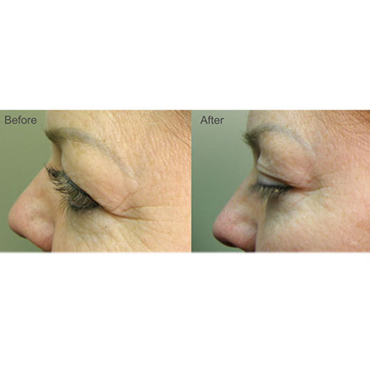Full Face Professional Light Therapy System