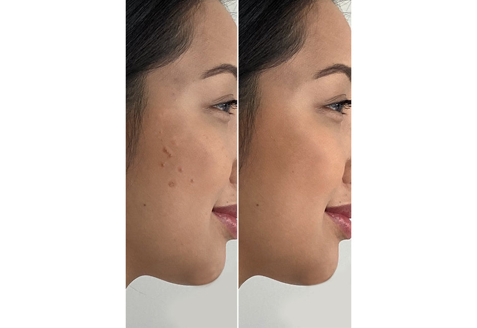 4-in-1 Microdermabrasion Tool