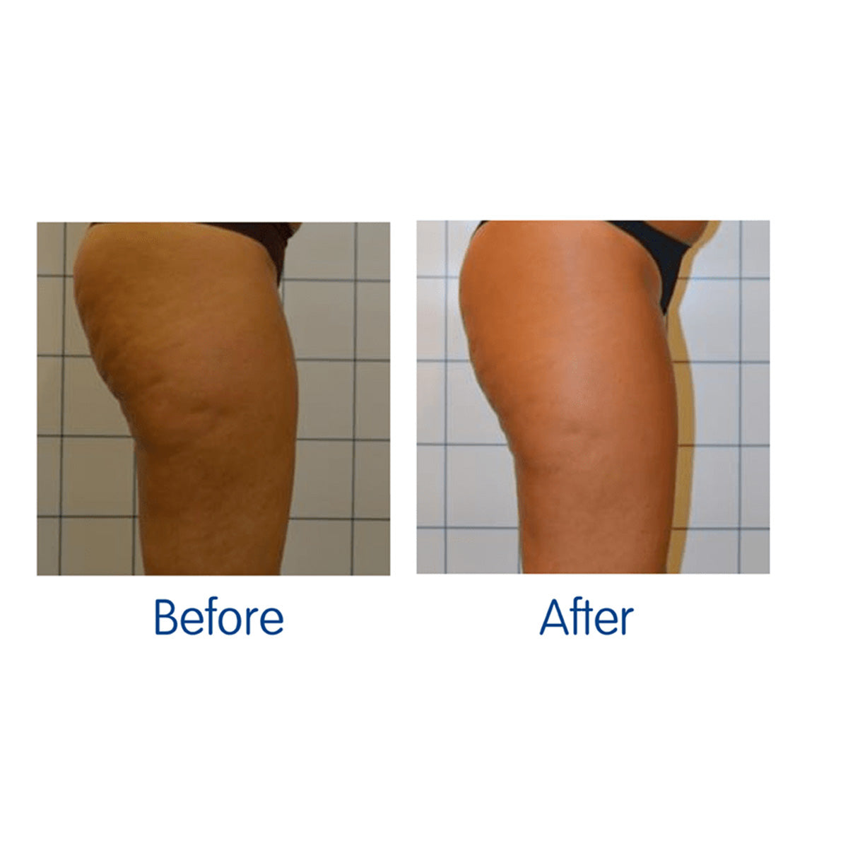 LED Cellulite Reducing Device
